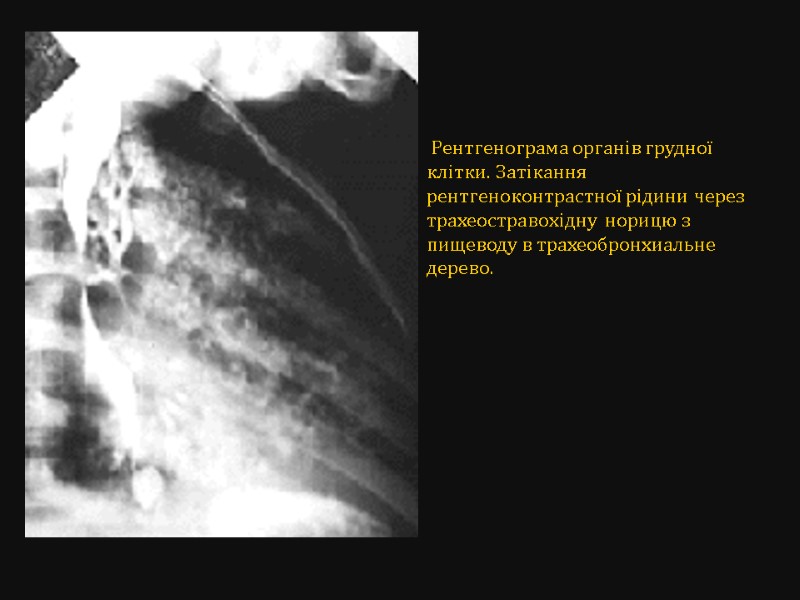 Рентгенограма органів грудної клітки. Затікання рентгеноконтрастної рідини через трахеостравохідну  норицю з пищеводу в